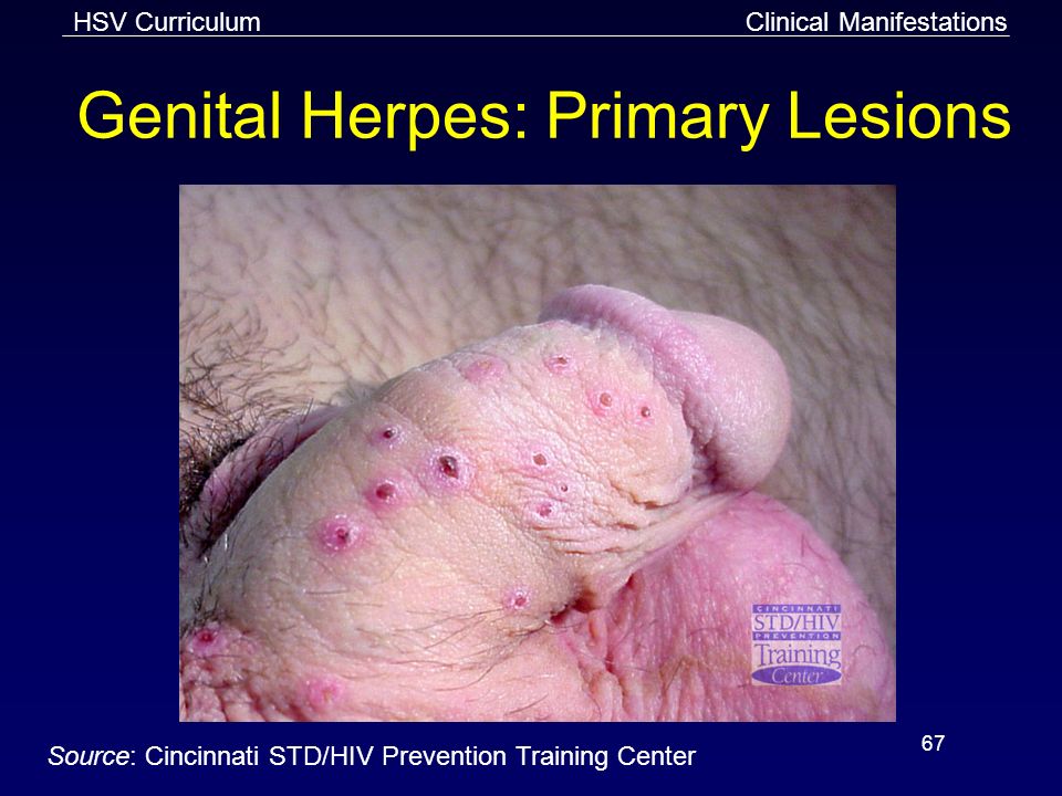 Presentation on theme: "HSV Curriculum 1 Genital and Perirectal Herpes...