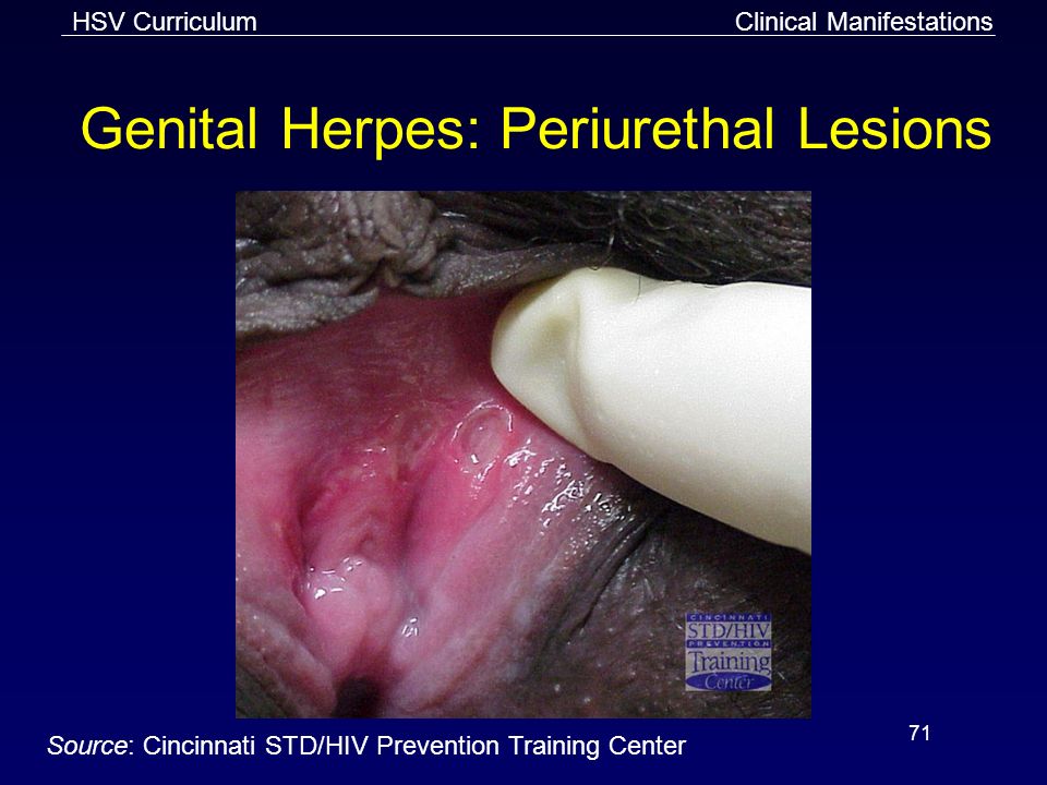 Presentation on theme: "HSV Curriculum 1 Genital and Perirectal Herpes ...