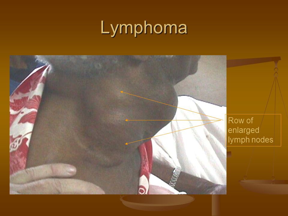 Lymphoma Row of enlarged lymph nodes