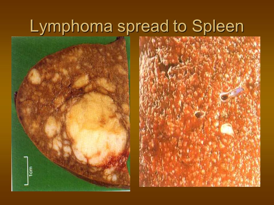 Lymphoma spread to Spleen
