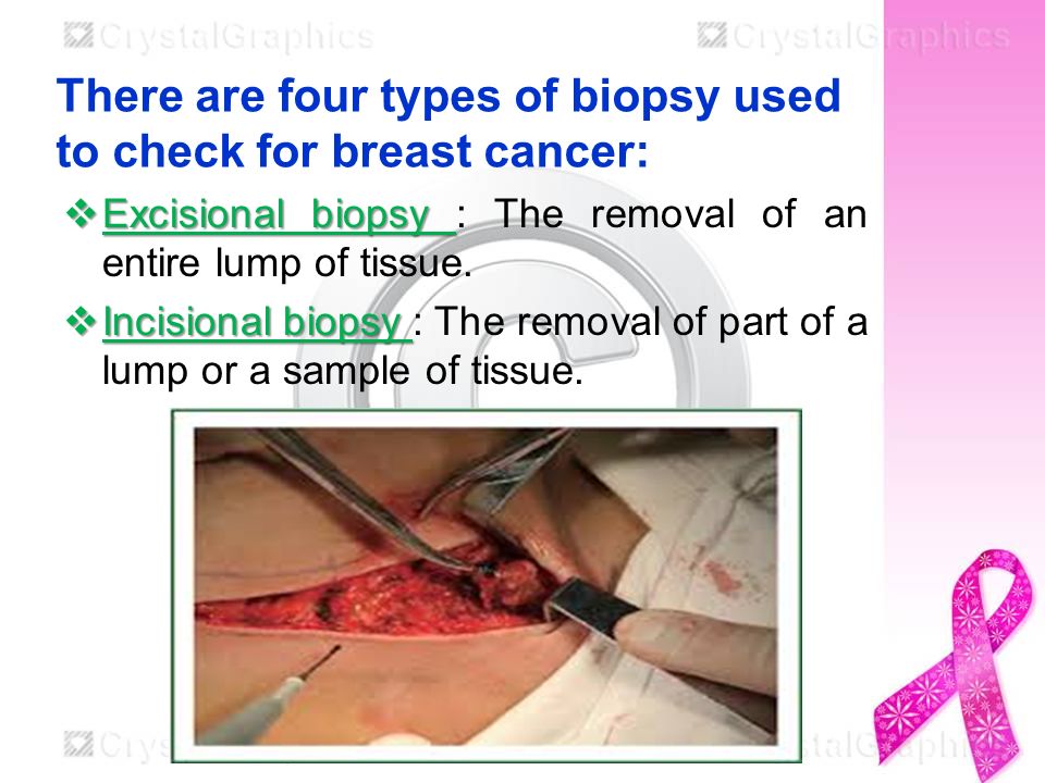 breast cancer biopsy types Breast cancer biopsy types