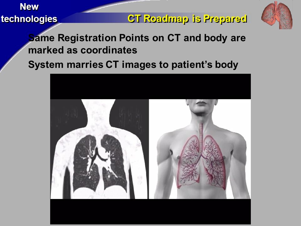 New technologies New technologies CT Roadmap is Prepared Same Registration Points on CT and body are marked as coordinates System marries CT images to patient’s body
