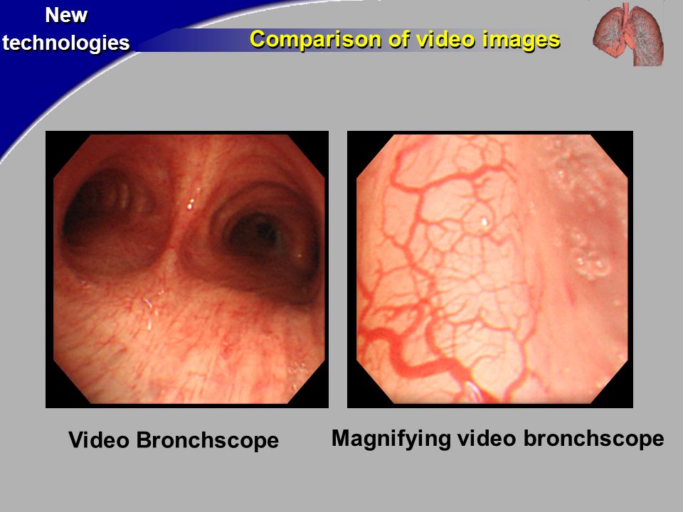 New technologies New technologies Video Bronchscope Magnifying video bronchscope Comparison of video images