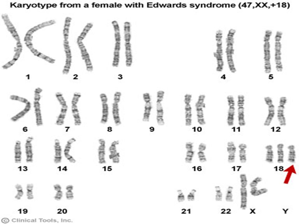 Кольцевая хромосома 2. Chromosomal diseases. Chromosome abnormalities. Chromosomal Mutations. Трисомия 8р23.2.