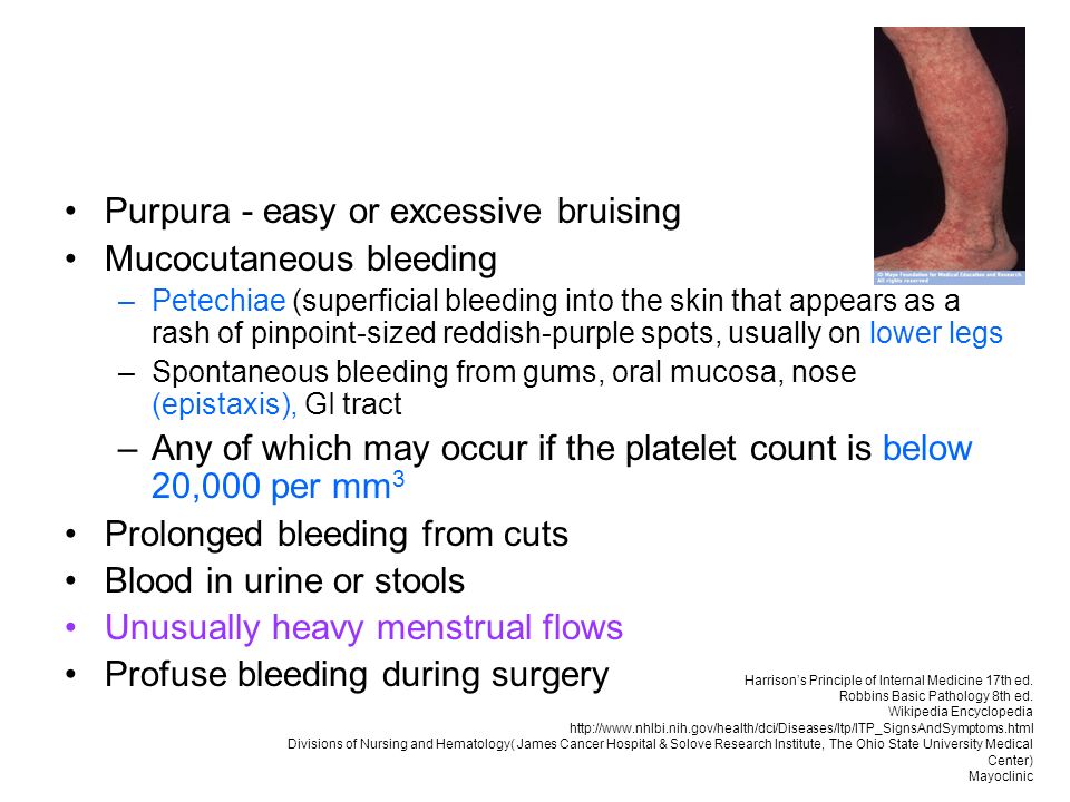 Idiopathic Thrombocytopenic Purpura Clinical Features. - ppt download