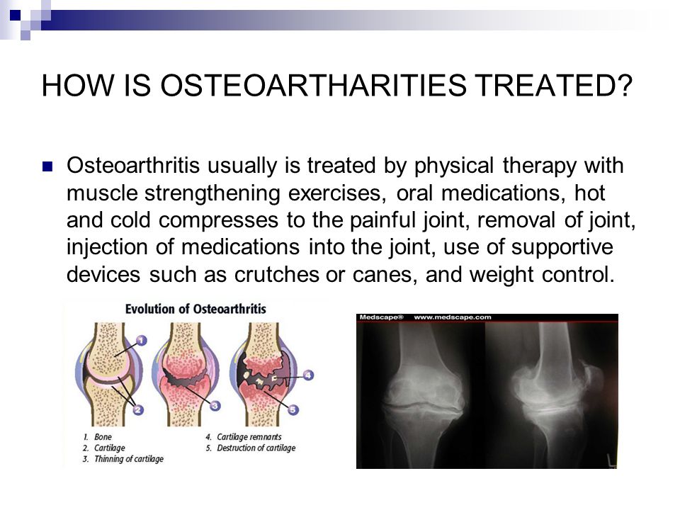 osteoarthritis medscape treatment)