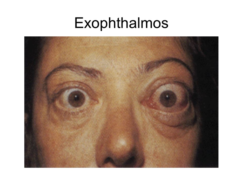 Exophthalmos