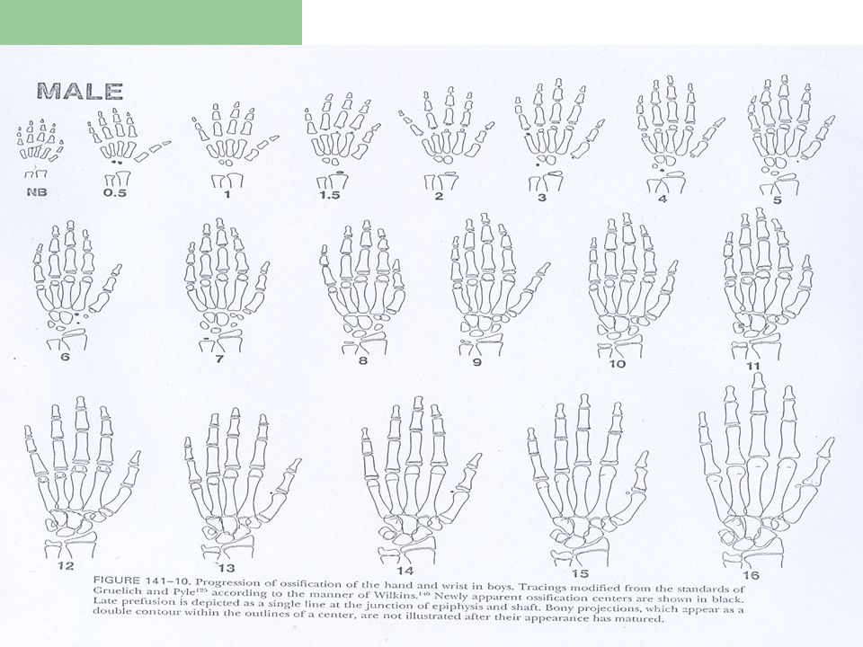 Bone Age Wrist Chart