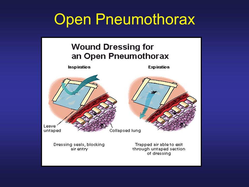Treating Penetrating Chest Trauma and Decompressing a Tension Pneumothorax.  - ppt download