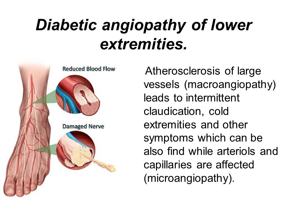 diabetic angiopathy of lower extremities