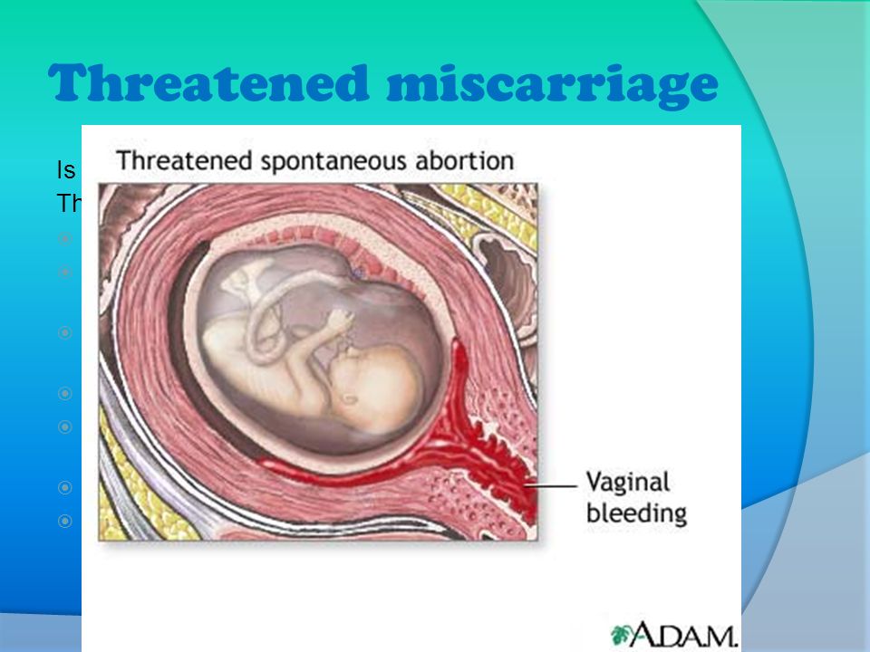 Threatened miscarriage Is the earliest stage of most spontaneous miscarriag...