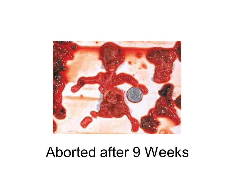 Aborted after 9 Weeks
