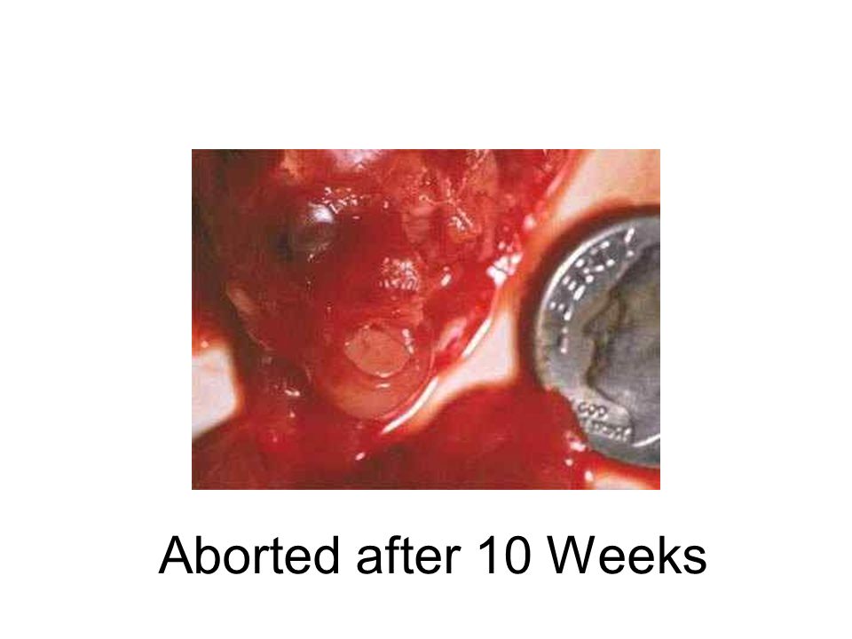 Aborted after 10 Weeks
