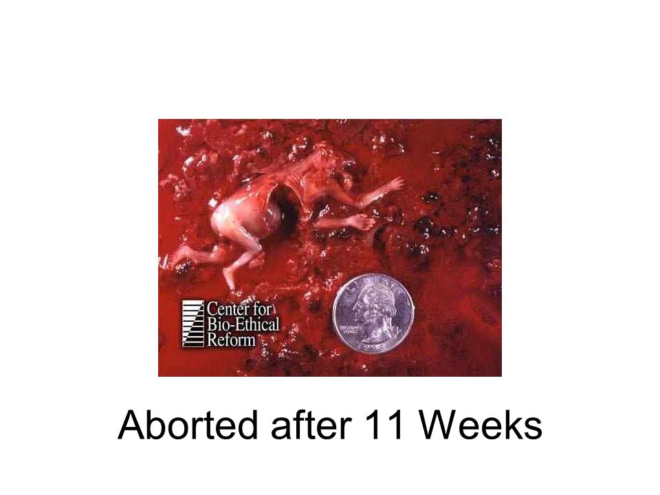 Aborted after 11 Weeks