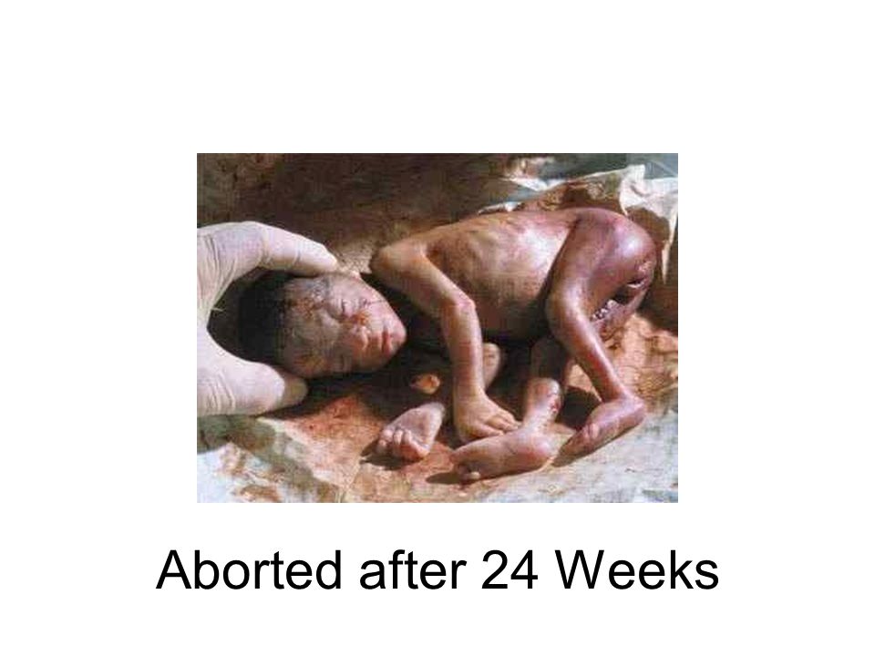 Aborted after 24 Weeks