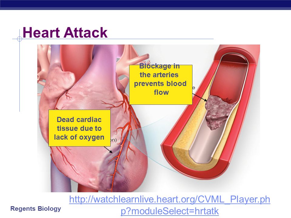Regents Biology Cardiovascular Disease (Heart Disease)  Atherosclerosis  deposits inside arteries (plaque) normal artery hardening of arteries