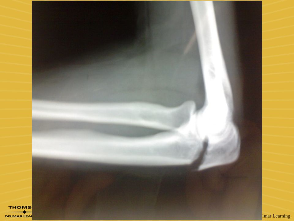 Трещина это перелом. Перелом локтевого отростка на рентгенограмме. Перелом локтевого отростка локтевой кости рентген. Оскольчатый перелом локтевого отростка рентген. Перелом локтевого отростка рентген.