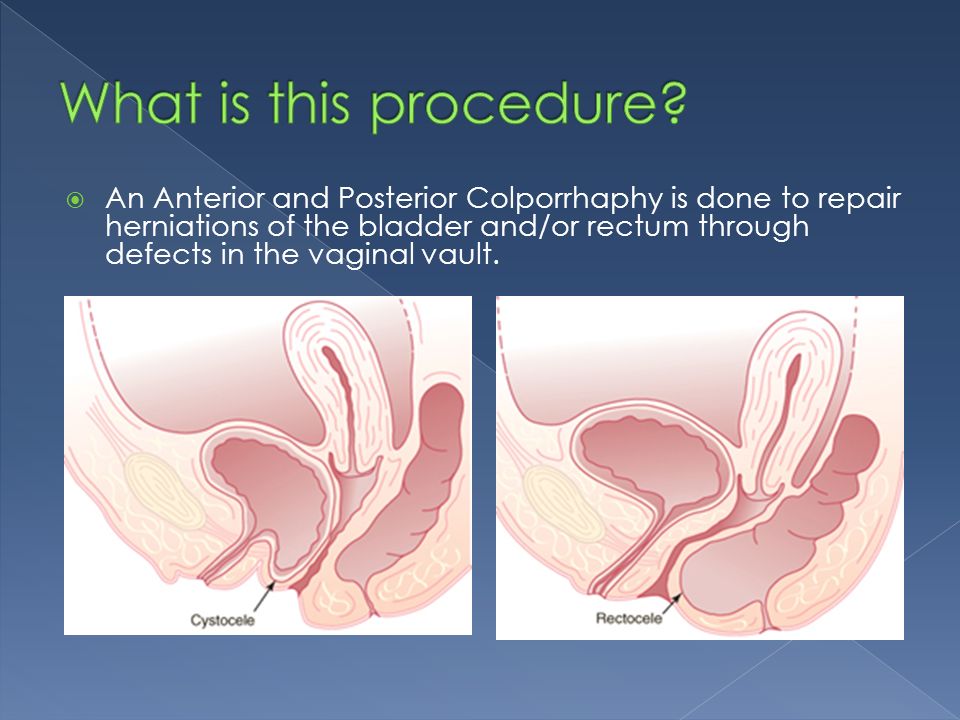 About your cystocele repair and sling