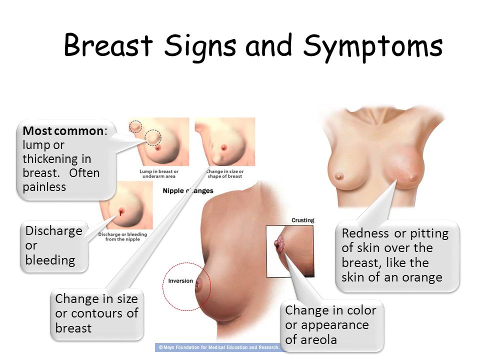 Breast Cancer Dr. Gehan Mohamed. Introduction Most common female cancer.  The incidence of breast cancer increases with age. 80% of cases occur in  post-menopausal. - ppt download