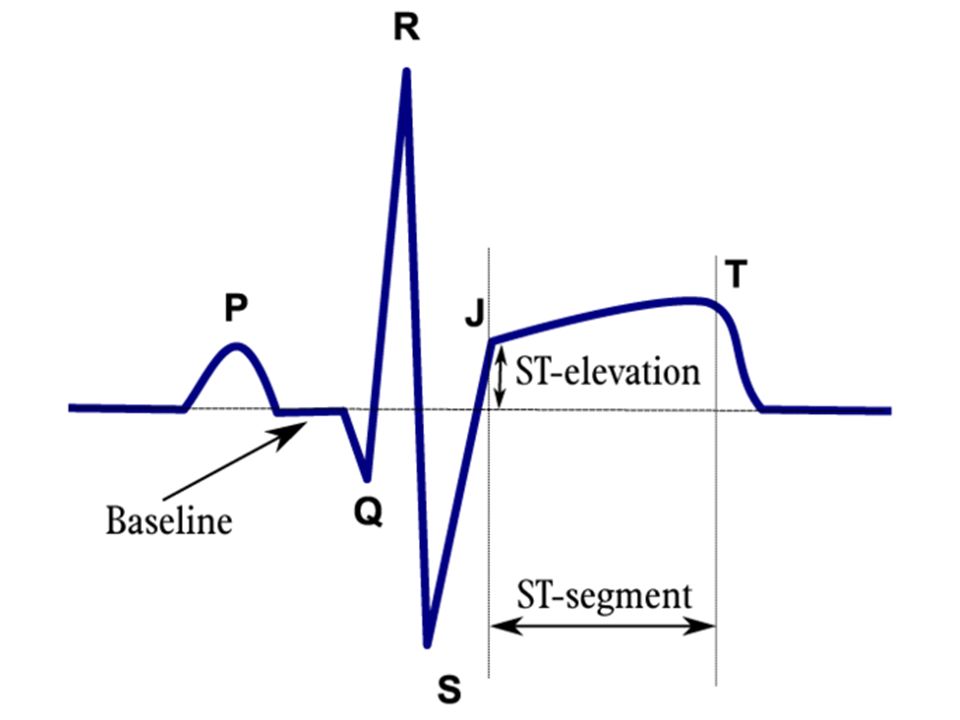 Сегмент st на экг. Элевация ст на ЭКГ. Подъем элевация сегмента St на ЭКГ. Сегмент St на ЭКГ верх на противоположном. Косовосходящая элевация сегмента St.
