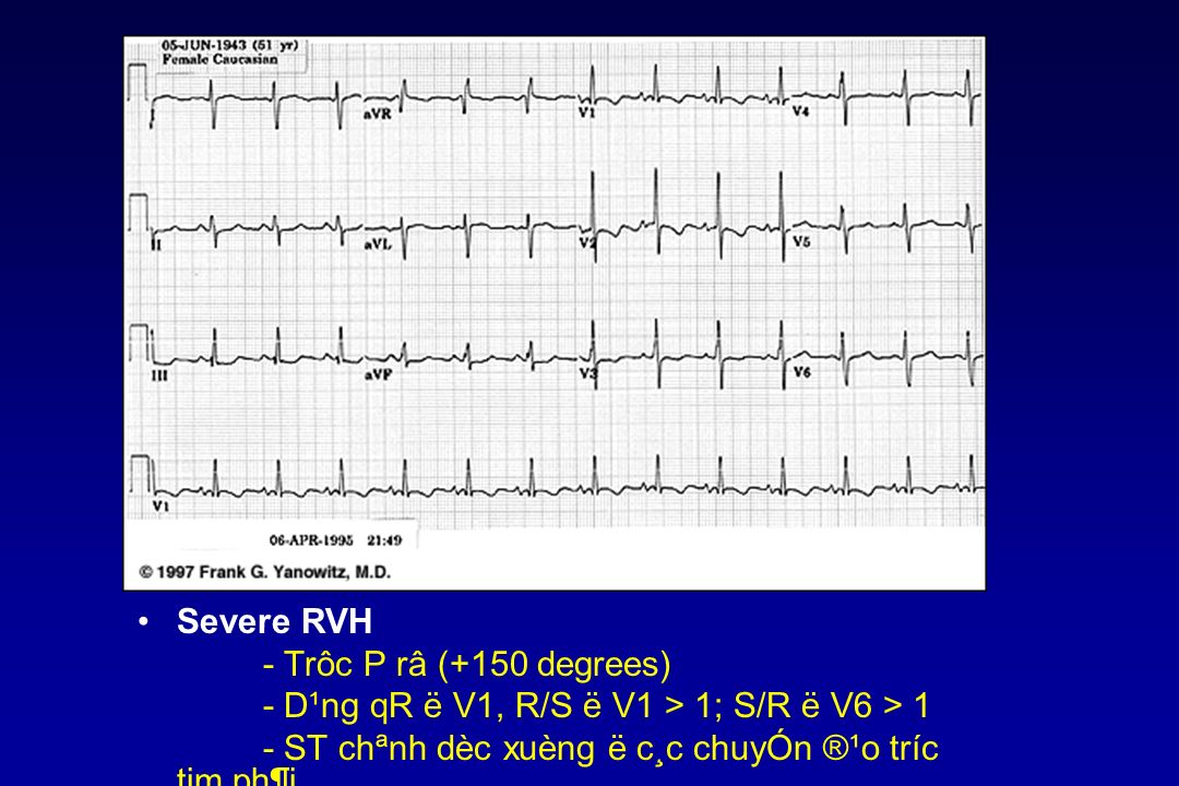 Test Ion Tim A Lvh Pvcs Precordial Leads Kh Ppt Download