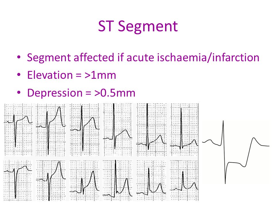 ST Segment Segment affected if acute ischaemia/infarction Elevation = >1mm Depression = >0.5mm