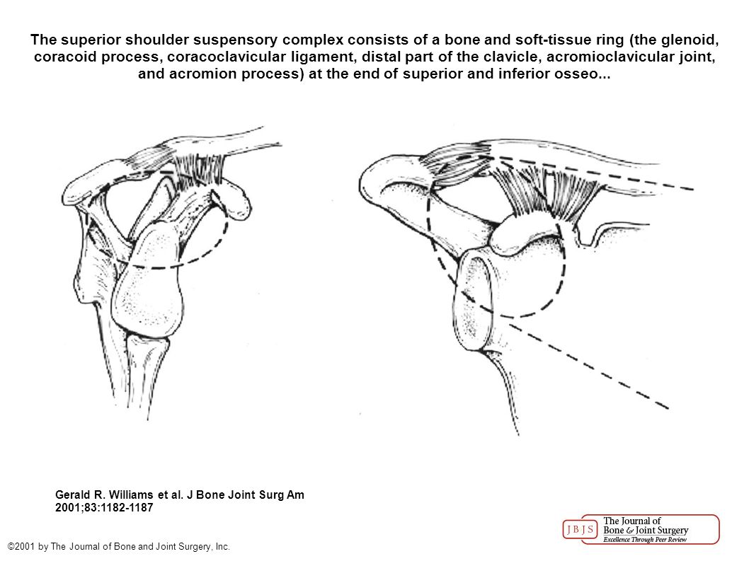The superior shoulder suspensory complex consists of a bone and soft-tissue ring (the glenoid, coracoid process, coracoclavicular ligament, distal part of the clavicle, acromioclavicular joint, and acromion process) at the end of superior and inferior osseo...