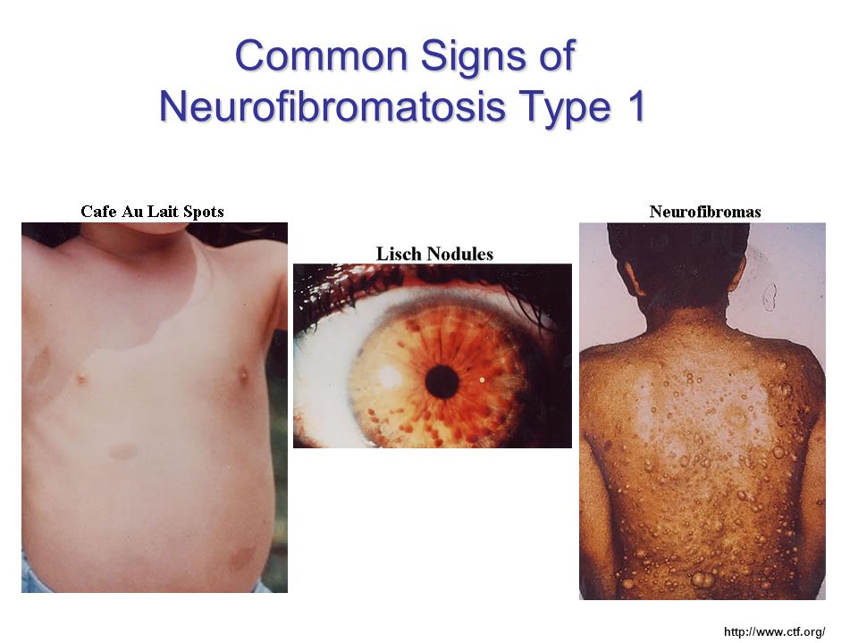 type 3 neurofibromatosis type 3 neurofibromatosis