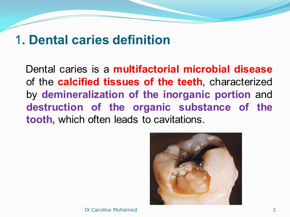 preventive dentistry i ii dental caries dr caroline mohamed1 dental caries definition