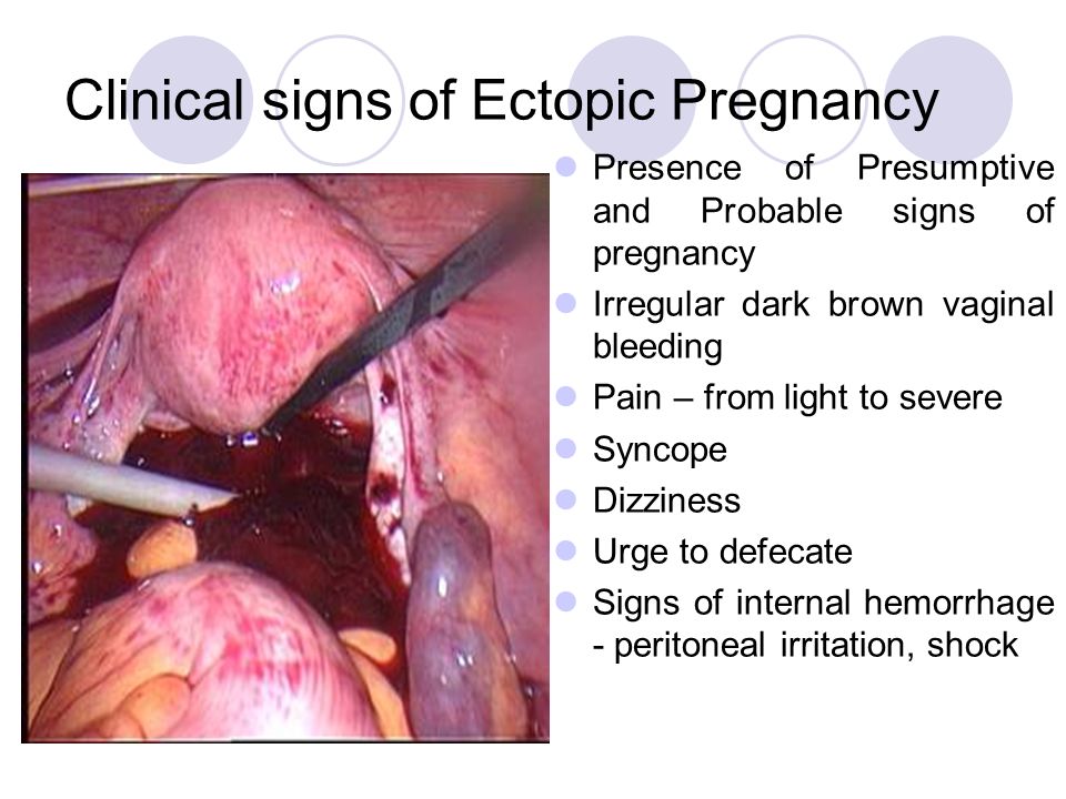 OBSTETRIC HEMORRHAGES Prepared by N. Bahniy. The main causes of hemorrhages  in the first half of pregnancy Spontaneous abortion Ectopic pregnancy  Hytadidiform. - ppt download