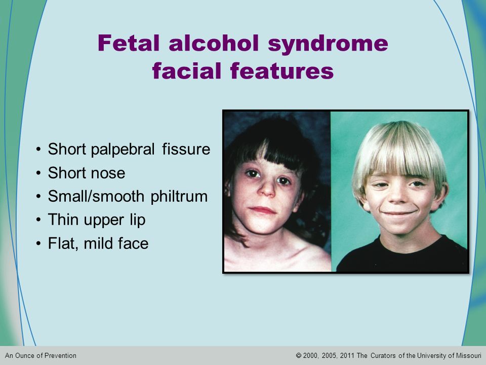 palpebral fissure fetal alcohol syndrome