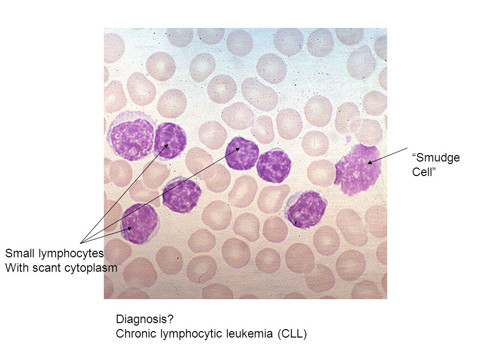 Diagnosis Chronic lymphocytic leukemia (CLL) Smudge Cell Small lymphocytes With scant cytoplasm