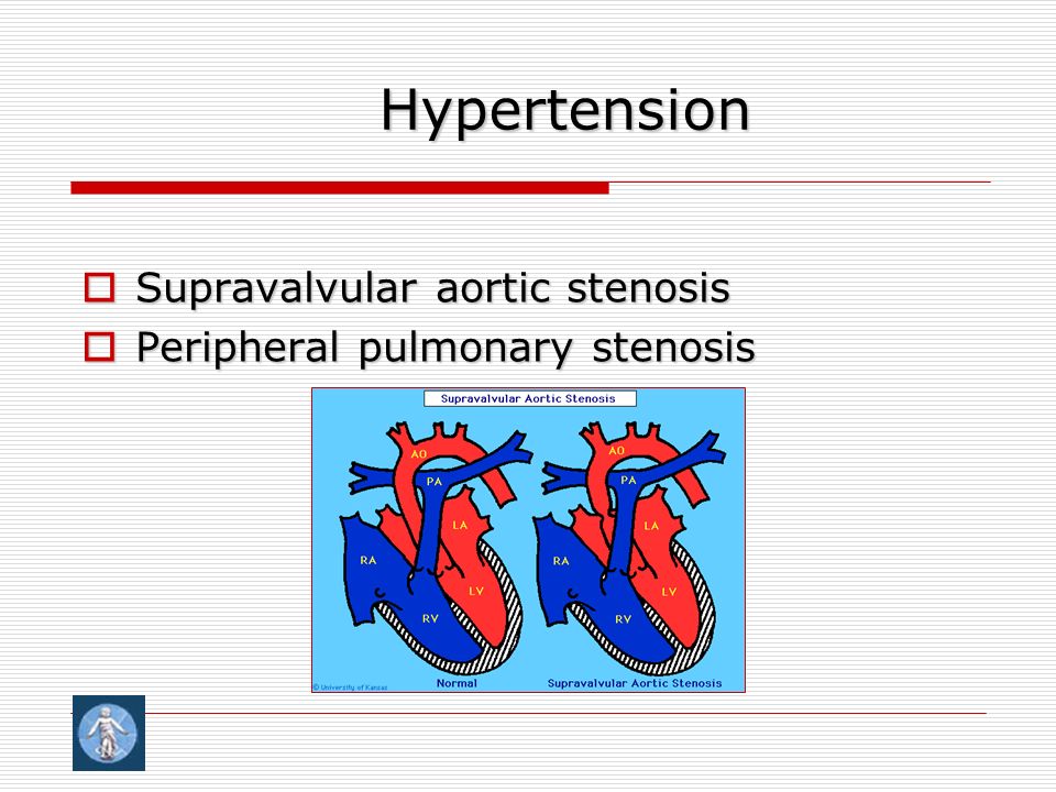 Hypertension  Supravalvular aortic stenosis  Peripheral pulmonary stenosis