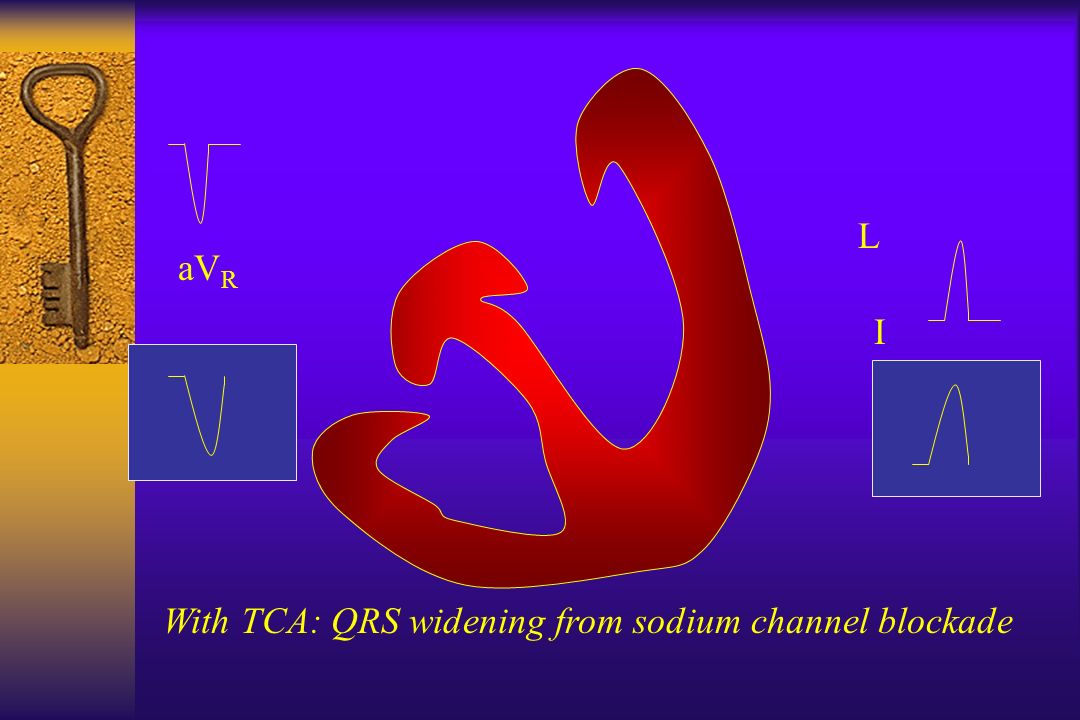 I L aV R With TCA: QRS widening from sodium channel blockade