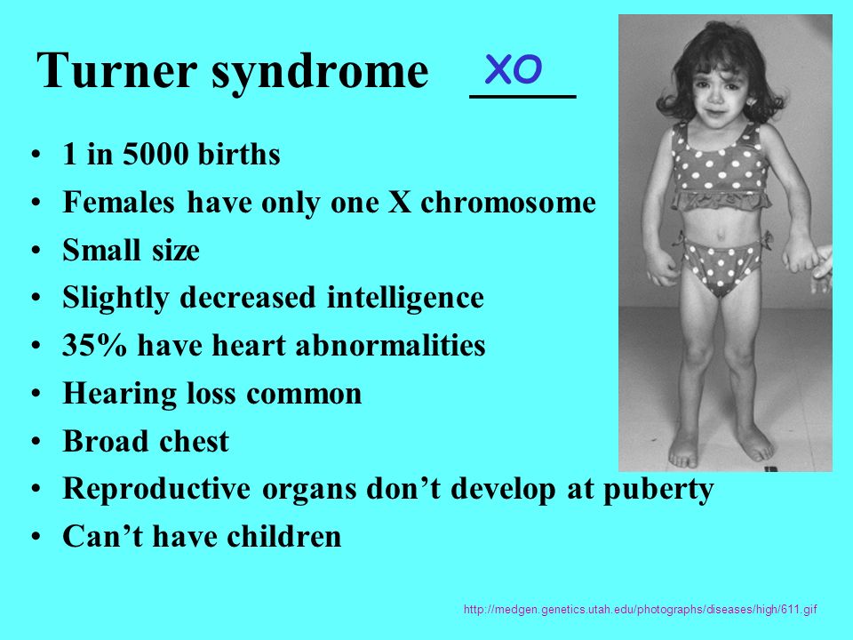 Синдром тернера какая хромосома. Синдром Тернера интеллект.
