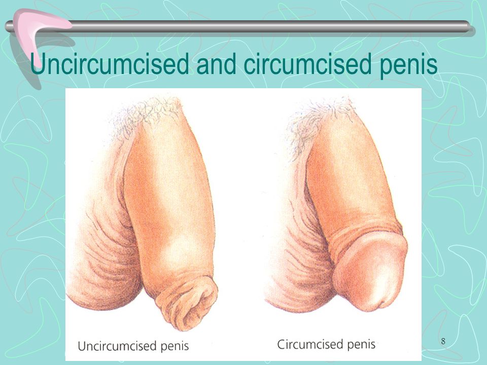 8 Uncircumcised and circumcised penis.