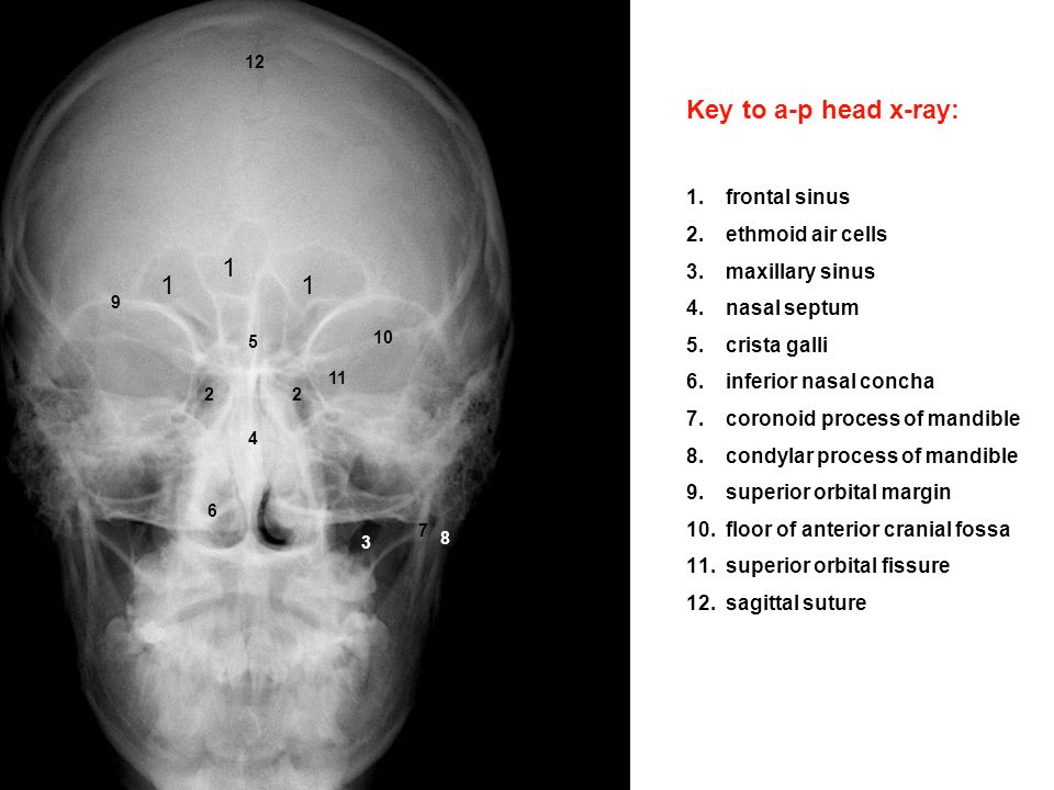 Identify On A P Head X Ray 1 Frontal Sinus 2 Ethmoid Air Cells 3 Maxillary Sinus 4 Nasal Septum 5 Crista Galli 6 Inferior Nasal Concha 7 Coronoid Process Ppt Download