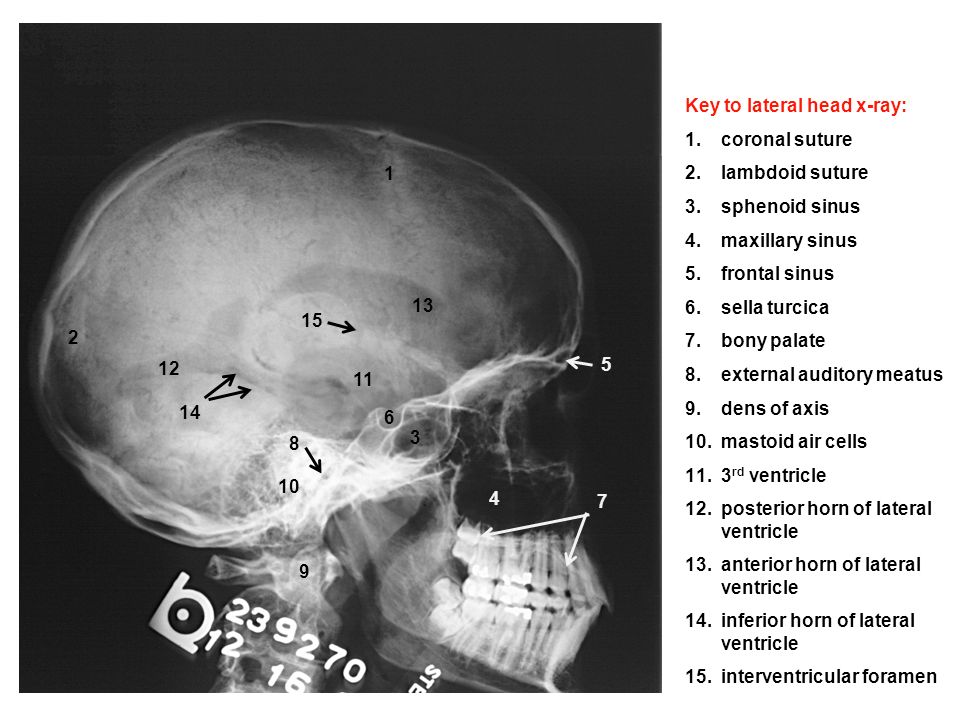 Identify On A P Head X Ray 1 Frontal Sinus 2 Ethmoid Air Cells 3 Maxillary Sinus 4 Nasal Septum 5 Crista Galli 6 Inferior Nasal Concha 7 Coronoid Process Ppt Download