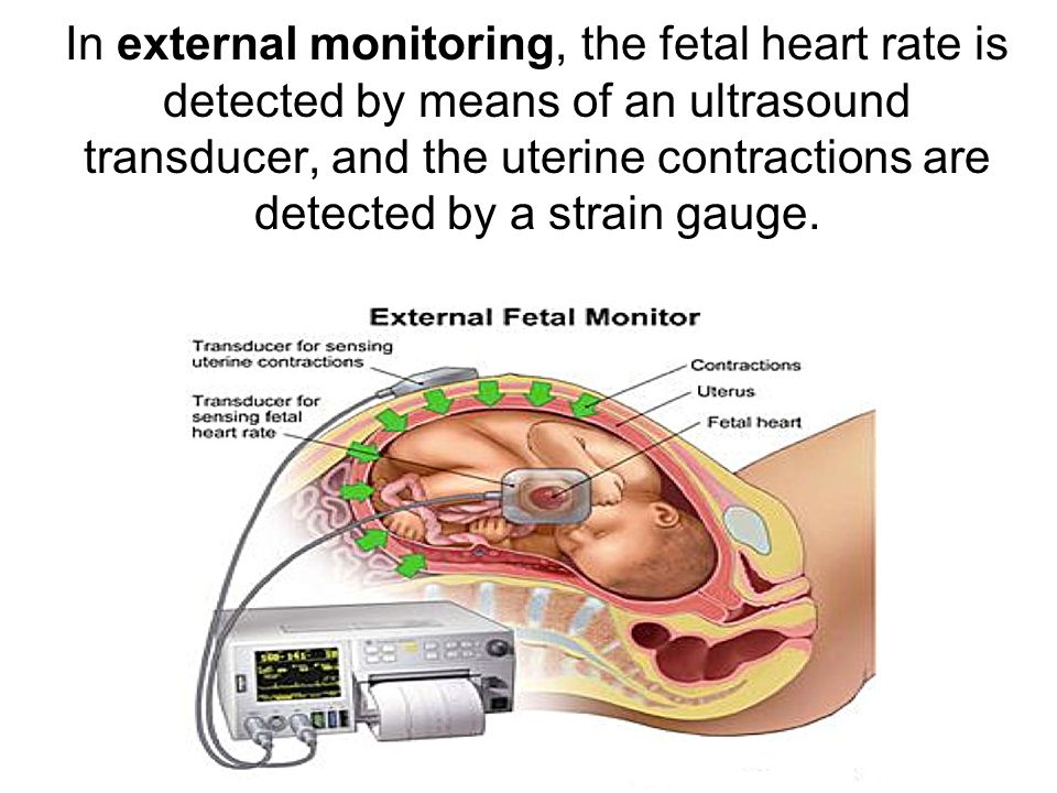 the fetal heart rate is detected by means of an ultrasound transducer, and ...