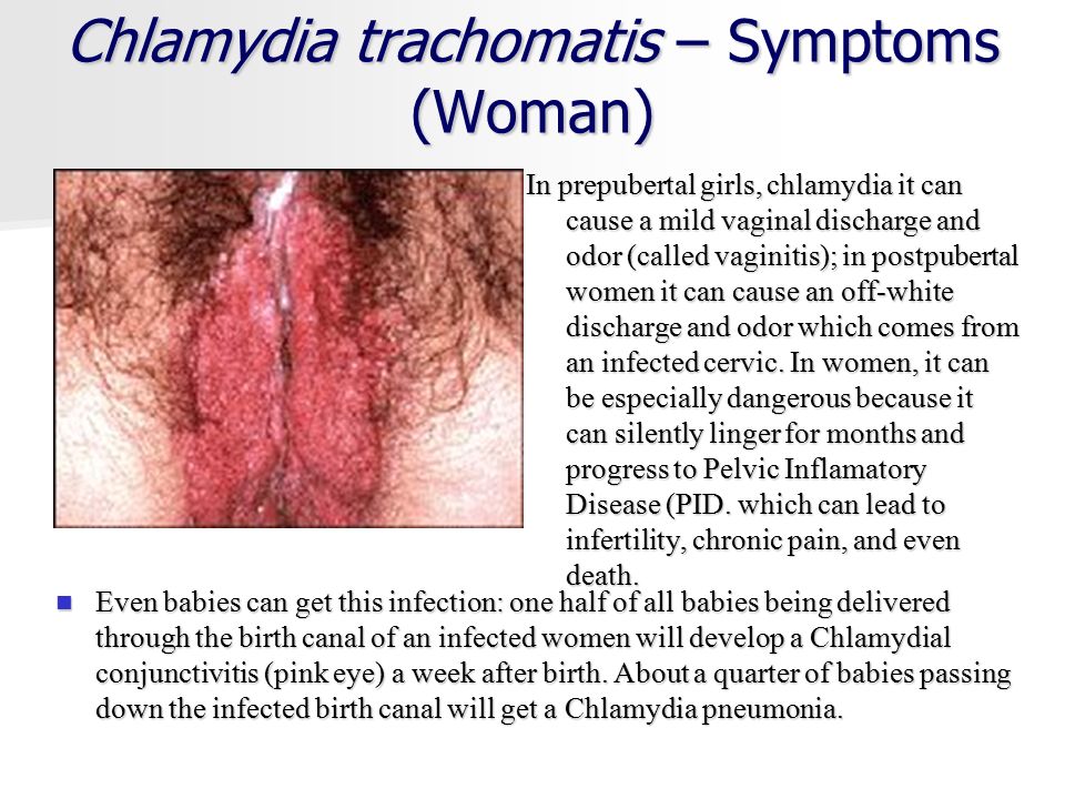 Most Common Vaginal Infectionsymptoms And Treatment