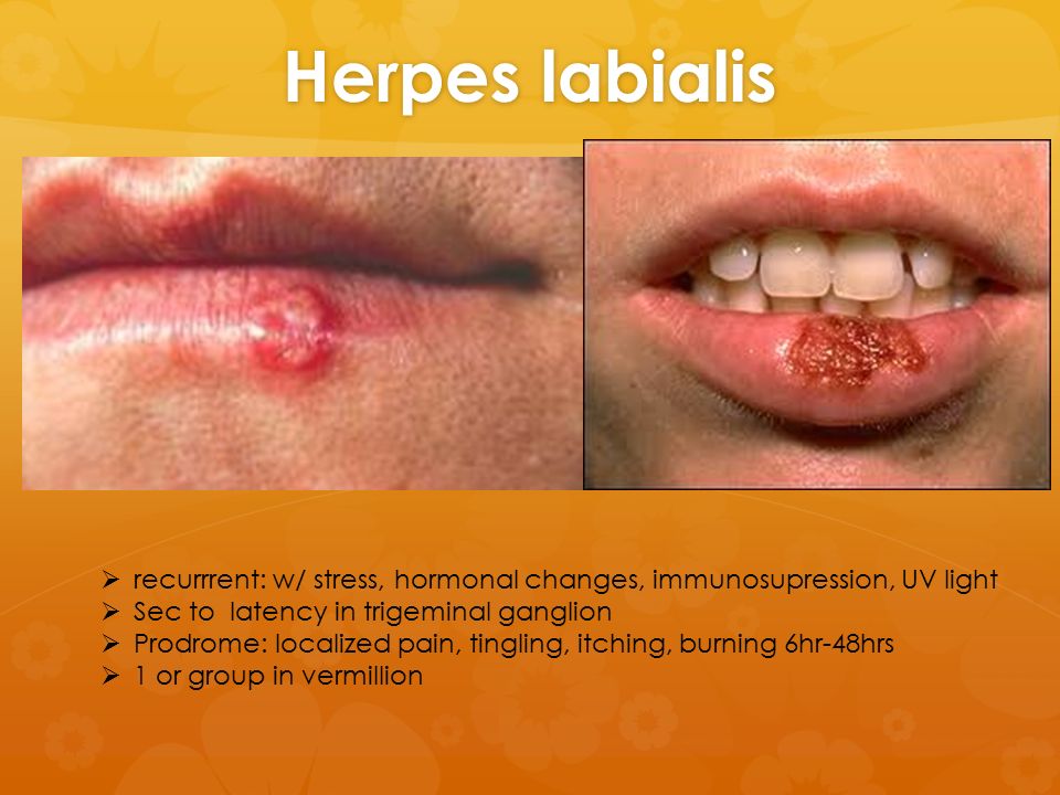 Herpes labialis ? recurrrent: w/ stress, hormonal changes, immunosupression...