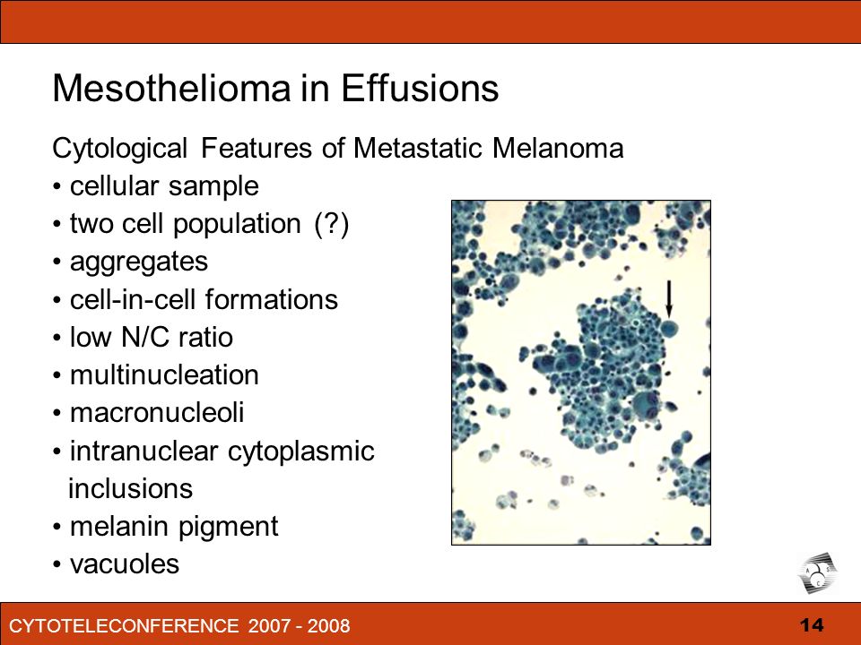 what are symptoms of mesothelioma