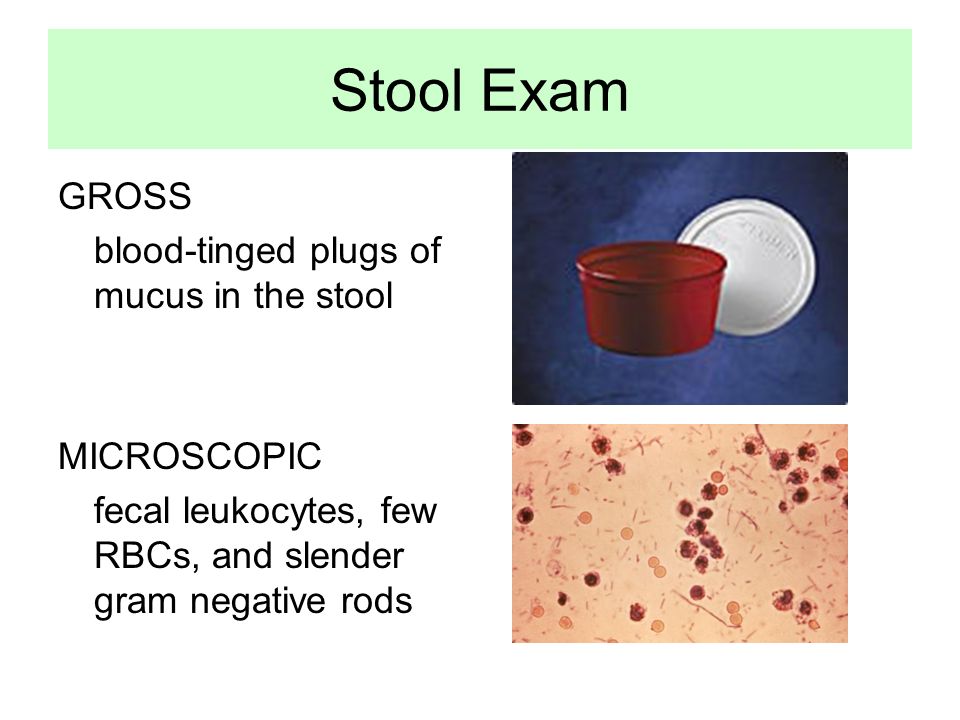 Case 2-A. 2 year old child 3 days diarrhea Stool – blood-streaked, 3-4x per  day Moderate grade fever, tenesmus, abdominal pain PE –Conscious, slightly.  - ppt download