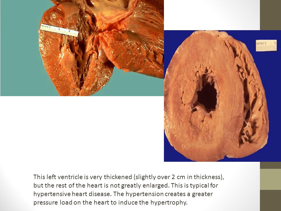 This left ventricle is very thickened (slightly over 2 cm in thickness), but the rest of the heart is not greatly enlarged.