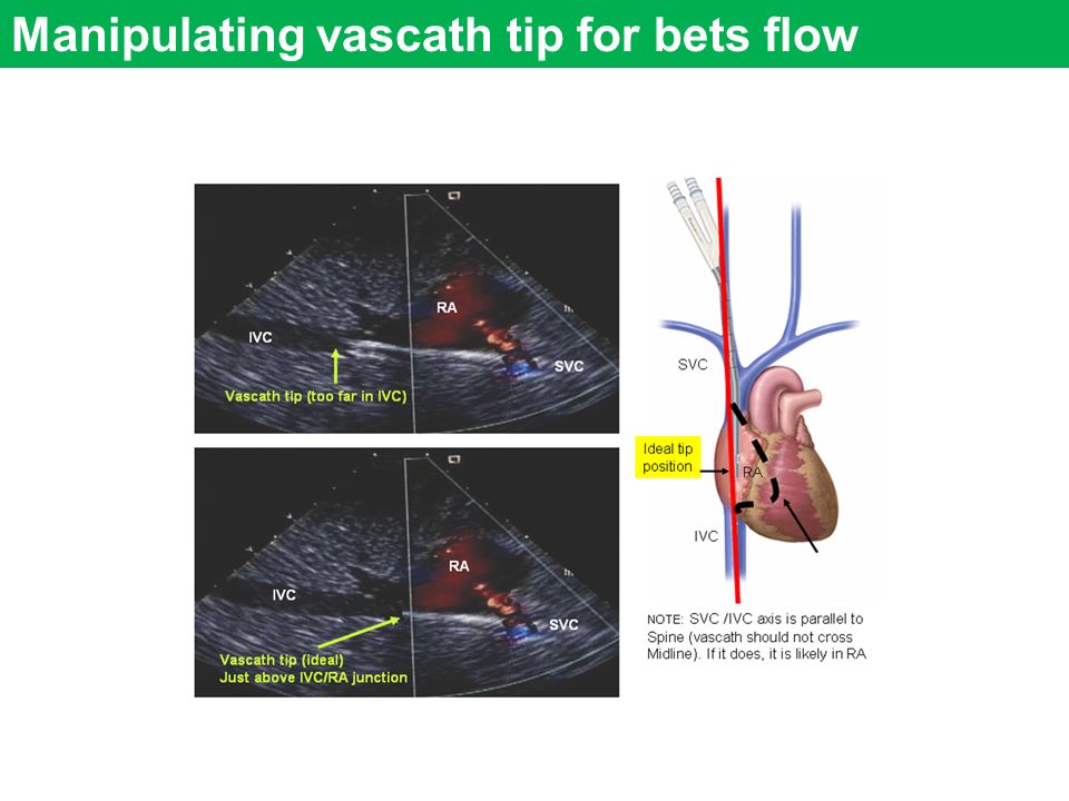 Manipulating vascath tip for bets flow