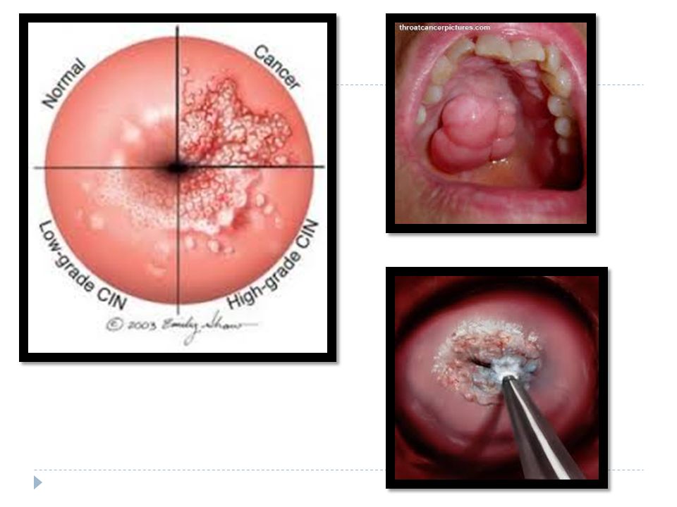 Penetration tease tube Oral and genital lesions after sex
