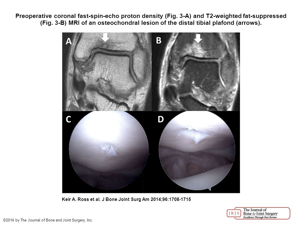 Functional And Mri Outcomes After Arthroscopic Microfracture