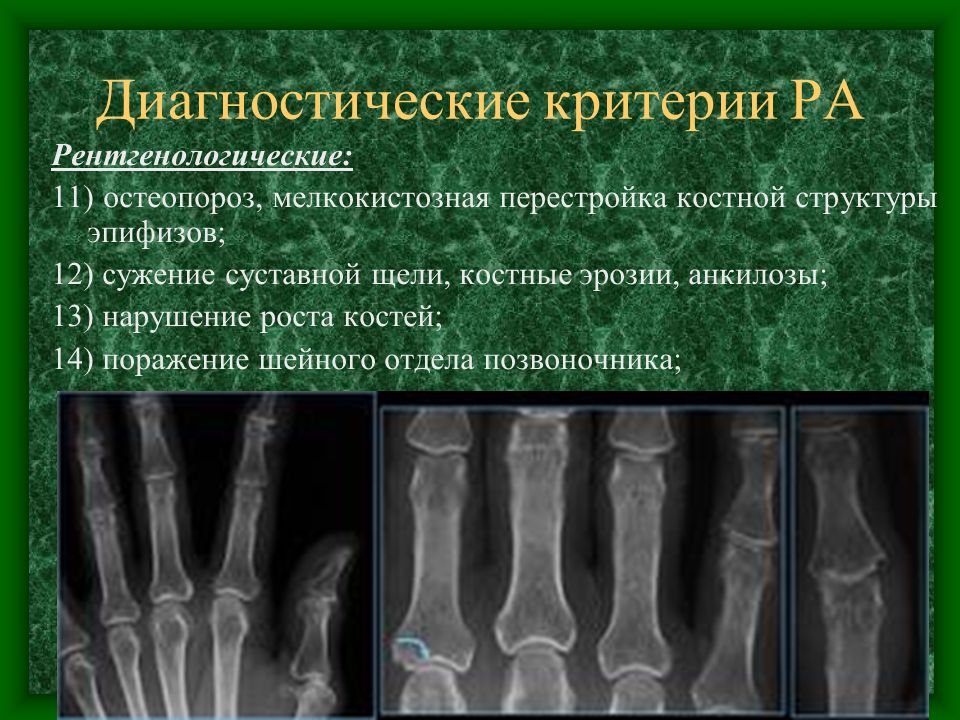 Ревматоидного артрита у детей клинические. Ревматоидный артрит костная эрозия. Ревматоидный артрит у детей этиология. Пауциартикулярный юношеский артрит.