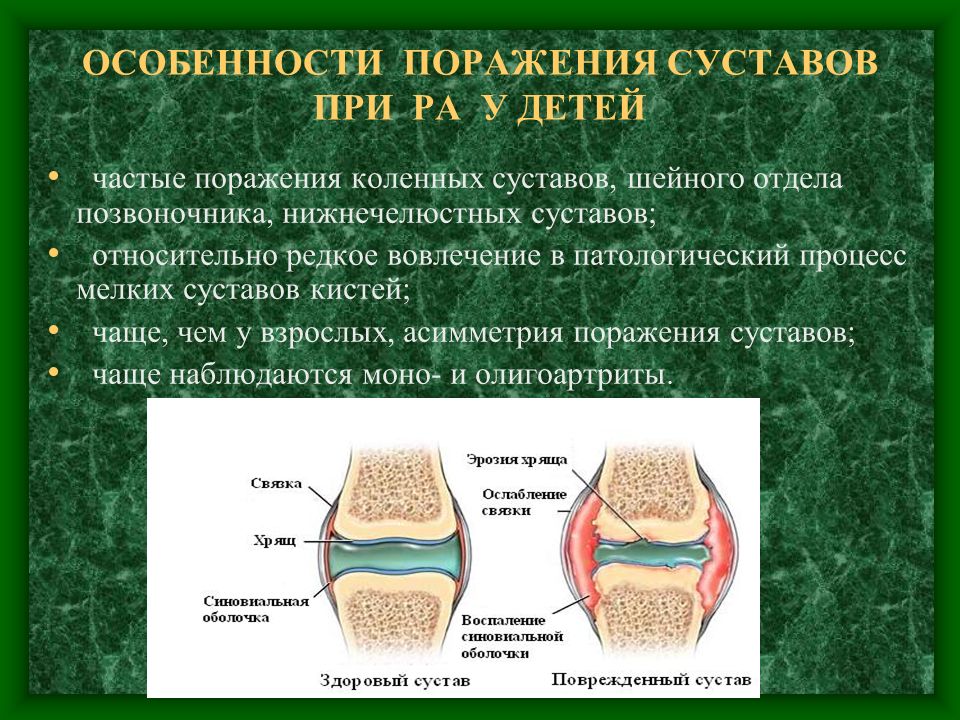 Поражение крупных суставов. Ревматоидный артрит симметричность поражения суставов. Поражения суставов у детей. Суставы при ревматоидном артрите. Ревматоидный артрит пораженные суставы.