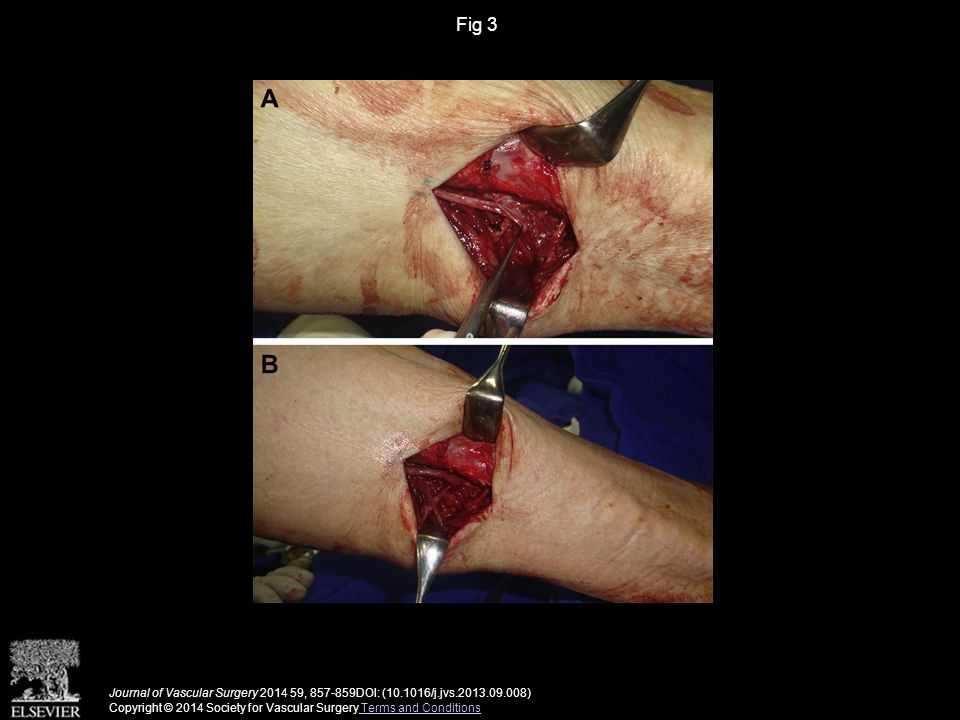 Fig 3 Journal of Vascular Surgery , DOI: ( /j.jvs ) Copyright © 2014 Society for Vascular Surgery Terms and Conditions Terms and Conditions